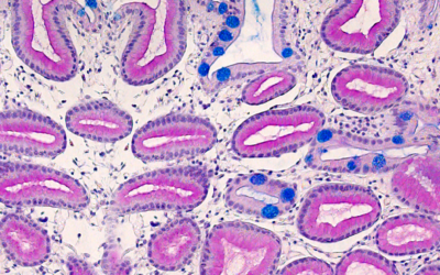 Goblet Cell Adenocarcinoma of the Appendix (GCA) 
