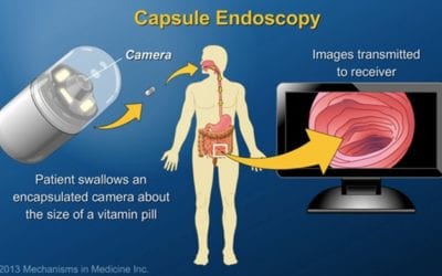 NHS Rolls Out Capsule Cameras to Test for Cancer