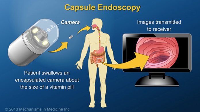 NHS Rolls Out Capsule Cameras to Test for Cancer