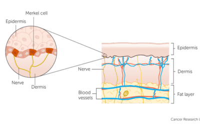 Merkel Cell Carcinoma (MCC) Skin Cancer